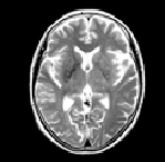 頭部MRI検査